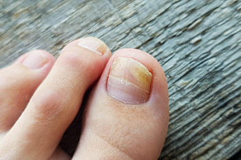 How to Treat a Torn Toenail: Home Care & Pain Management