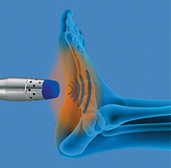 Radial Pulse Wave Therapy