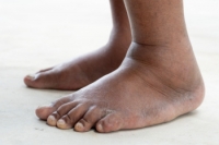 Common Causes of Swollen Ankles
