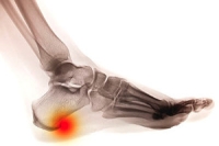 A Small Bony Growth May Indicate a Heel Spur