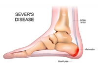 Definition and Affected Population of Sever’s Disease