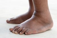 Managing Swelling in the Legs and Ankles