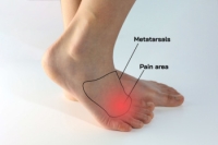 Morton’s Neuroma Facts