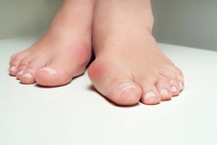 Dealing With a Bunion