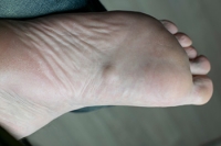 What You Need to Know About Plantar Fibromas